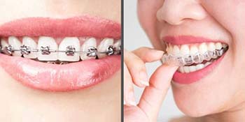 Ceramic Braces vs Invisalign: Which Is Right for You?